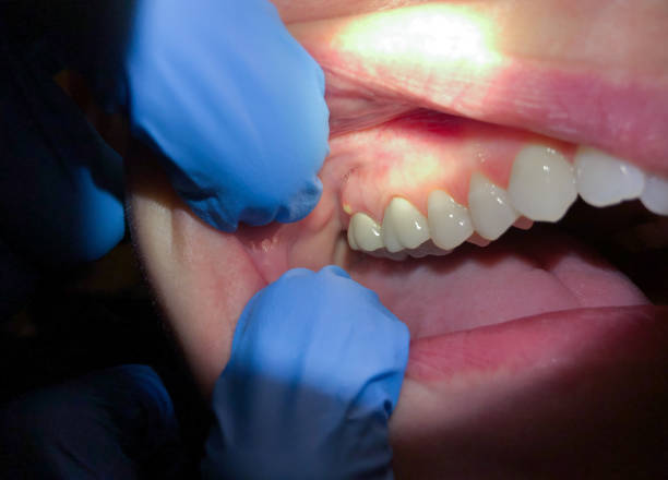 Best Emergency Treatment for Oral Infections in Susquehanna Trails, PA